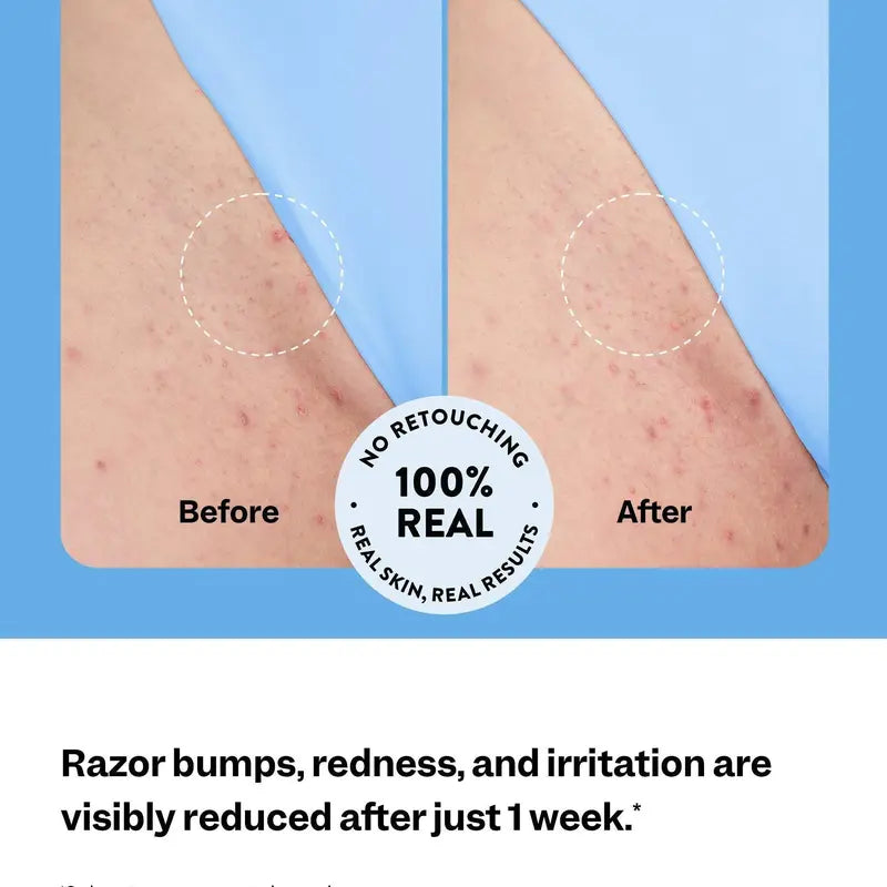 TAILEDEN™Smoothing Solution Ingrown Hair Treatment: Glide Your Way to Silky-Smooth, Bump-Free Skin